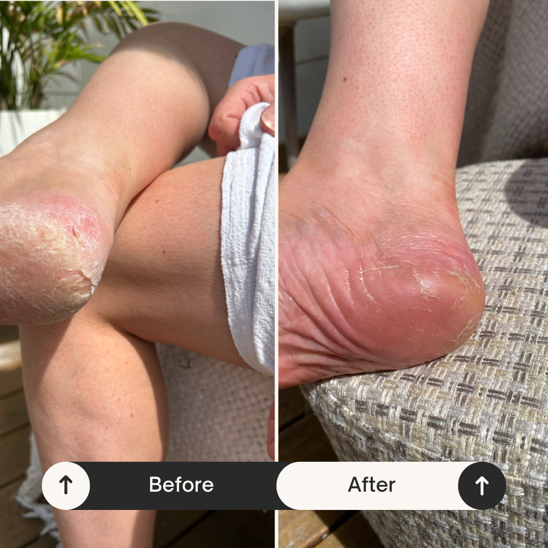 Elite Essentials™ Electric Foot Callus Remover