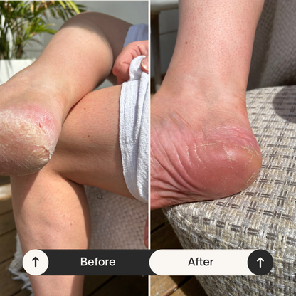 Elite Essentials™ Electric Foot Callus Remover